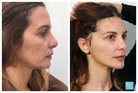 Facelift Treatment Manchester