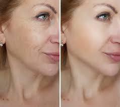 Skin Tightening Treatments in Manchester